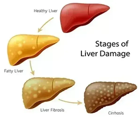 ALCOHOL AND LIVER DISEASE