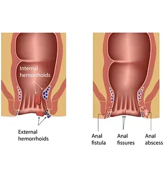 Hemorrhoids and Fissures